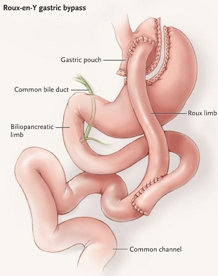 Diagram of Gastric Bypass Surgery (Roux-en-Y Gastric Bypass)
